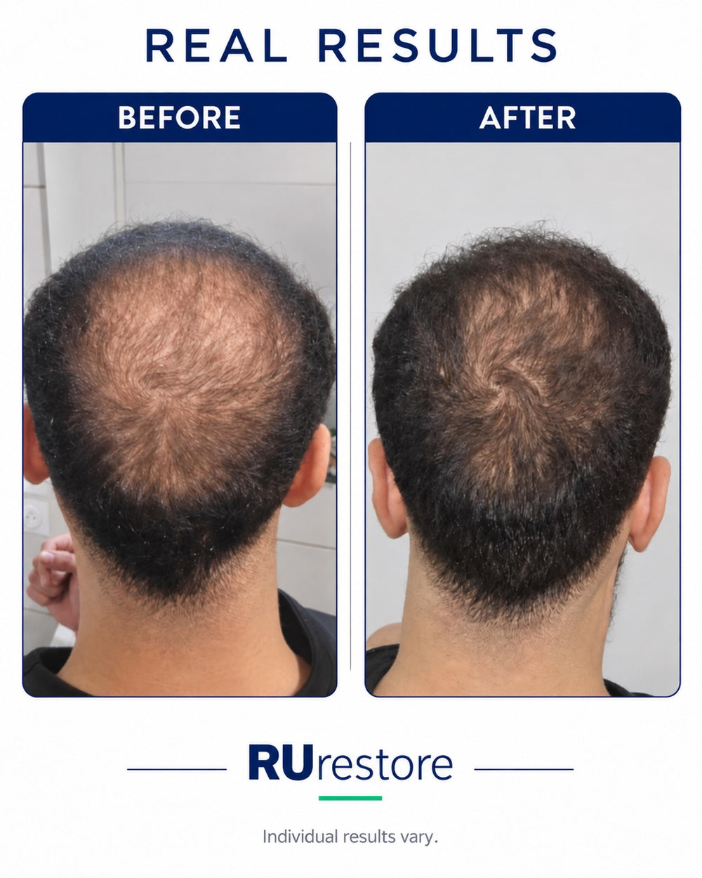 Hairline & temples, before and after
